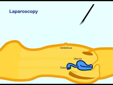 Laparoscopy