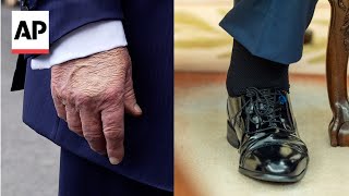 Trump diagnosed with chronic venous insufficiency after swollen legs, bruised hand