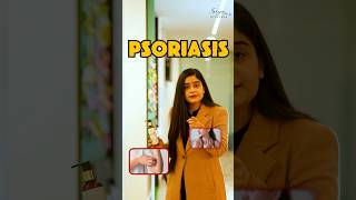 Best Body lotion for Psoriasis | सोरायसिस से पाए छुटकारा | Siya Ayurveda