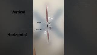 Vertical Mattress Suture #surgicalskills #suturing #surgery #surgeon #medicine