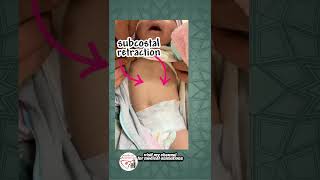 Subcostal Retraction