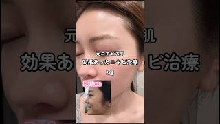 私が効果感じたニキビ治療#美容整形#美容#整形#肌管理#垢抜け#スキンケア#コスメ#ニキビ