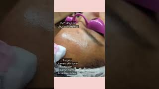 Obagi Chemical Peel|Targets Uneven Skin Tone|Large Pores|Blemishes|Oily Skin Treatments|Smooth Skin