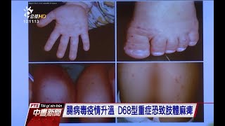 2歲女童染腸病毒D68型重症 國內首例 20170905公視中晝新聞
