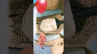 Innovative Spine Fracture Treatment: Balloon + Cement 🎈#shorts