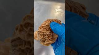 Stomach Ulcers
