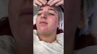 HydraFacial treatment at Thérapie Clinic💜
