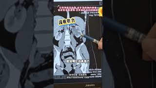 直观的给大家看一下肾脏在长期积水下即使输尿管得到畅通肾脏的形态也会发生改变 所以说发现积水就及早的处理输尿管狭窄 肾积水 尿路修复 医学科普 抖出健康知识宝藏