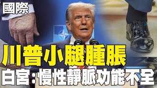 【每日必看】川普小腿腫脹 白宮:慢性靜脈功能不全20250718