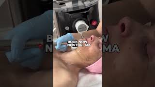 Effortless Facelift #forma #facelift #nodowntime #youthfulglow #painlesstreatment #skincare