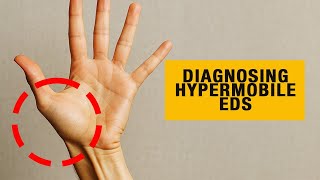 Revising the Hypermobile EDS Criteria with Dr. Pradeep Chopra (Ep 154)