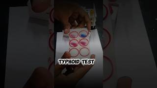 Typhoid test || widal test || #shortsfeed #shortvideo