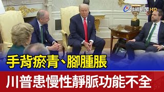 手背瘀青、腳腫脹 川普患慢性靜脈功能不全
