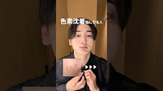 色素沈着に悩み続けたメンズが選ぶ「ブランド別TOP美容液」｜#垢抜け #スキンケア #美白 #ニキビ #fyp #おすすめ #추천