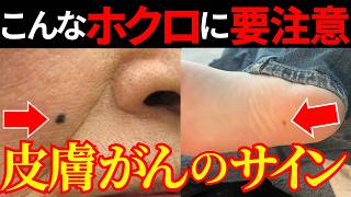 【医師監修】危険な「ほくろ」を絶対に見逃さないで！皮膚がんの危険サインや検査法・治療法・予防法を徹底解説