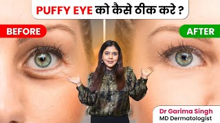 Dark Circles Aur Puffy Eyes Ka Permanent Solution Kya Hai? | कारण और इलाज | Dermatologist