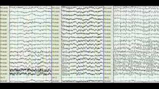 EEG