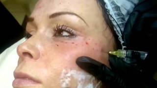 Viscoderm Mesotherapy Injectible Training
