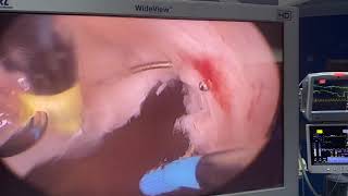 Amazing Hysteroscopy, transvaginal myoma resection