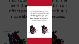 What is HCM?