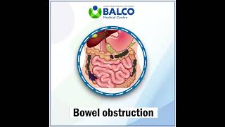 Symptoms of gastrointestinal stromal tumor | GIST | Balco Medical Centre
