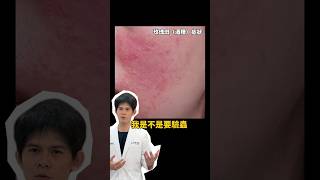 舒利達不是蠕形蟎蟲多才能用！│ 皮膚科黃千耀醫師