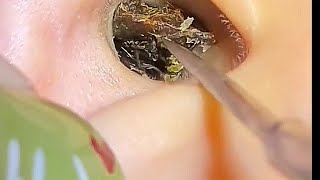 ASMR Ear Cleaning – They Lived With This Blockage for 10 YEARS
