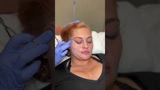 FACELIFT LIKE RESULTS IN MINUTES WITH PDO THREADS #youtubeshorts #pdothreadlift