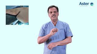 Complex Surgery in Morbid Obesity | Dr. Girish SP | Aster RV