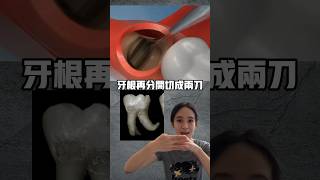 影響拔水平智齒腫多大的主要原因#拔智齒