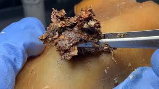Sharp Ingrown Trimmed! Professional Pedicure DR LEE’S ULTIMATE X192306 2282