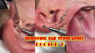 EAR STONE ACNES RMOVAL #31