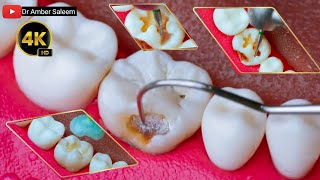 *"Tooth Restoration with White Filling: From Decay to Perfect"* Root Canal Treatment / rct treatment