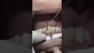 Composite restoration with fiber post before the zirconia crowns for all anterior teeth #dentist