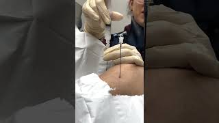 🏋 Who would benefit from the Radiofrequency Ablation (RFA) for the right knee?