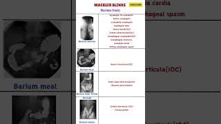 Mackler Blinks- Barium Study