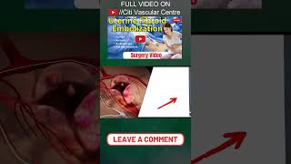 non-surgical treatment for uterine fibroids   #health #fibroids