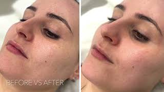 Obagi Blue Peel, Rejuvenate and Refresh your Skin!