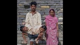 【実際の動画：インドの双子の奇形児】まるでベトちゃんドクちゃん。下半身がつながった結合双生児の兄弟。