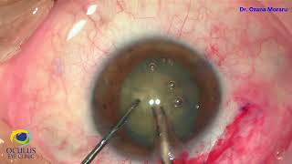 Phacoemulsification of mature cataract in the presence of Artisan Refractive lens for high myopia