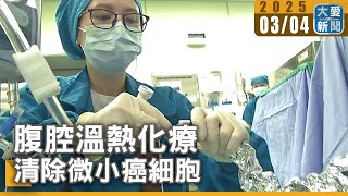 腹腔溫熱化療 清除微小癌細胞｜大愛新聞 @DaaiWorldNews