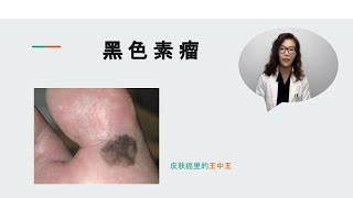 黑色素瘤 - 皮肤癌里的王中王