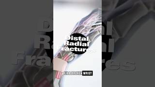 Distal Radius Fracture: what you should know! 🦾 #shorts