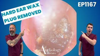 Compacted Ear Wax Block Removed! So Satisfying! - EP1167