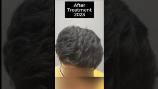 "Hair PRP Transformation at CARA | Before & After Shots"  #prptreatment