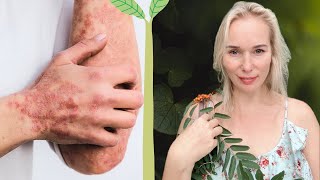🌿PSORIASIS - Skin Care #psoriasis