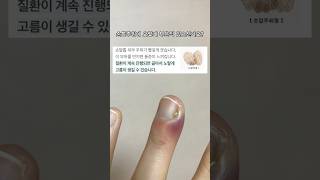 징그러우면 보지마세요☹️ #생인손 #조갑주위염