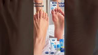 Say Goodbye to Fungal Nails Fast – Scholl’s #1 Trusted Treatment