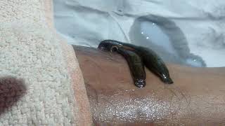 Leech therapy in eczema