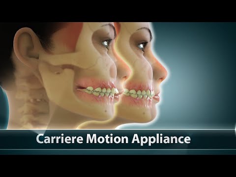 Carriere Motion Orthodontic Treatment | Curveia Dental Animation | Patient Education Video